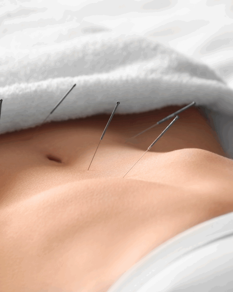 acupuncture in Toronto